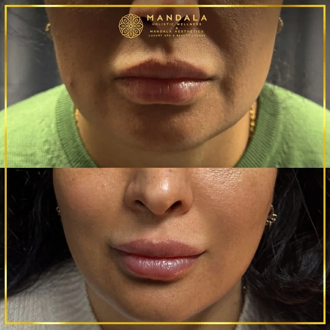 HIFU before and after results showing the lower face, chin and jawline at Mandala Aesthetics in Preston, Melbourne.