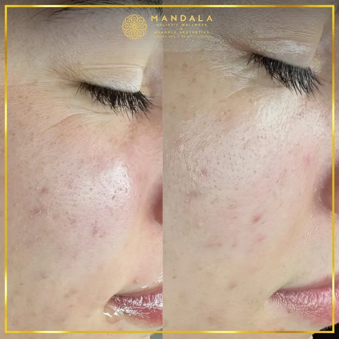 Facial treatment before and after results showing refreshed, hydrated and glowing-looking skin at Mandala Aesthetics in Preston, Melbourne.