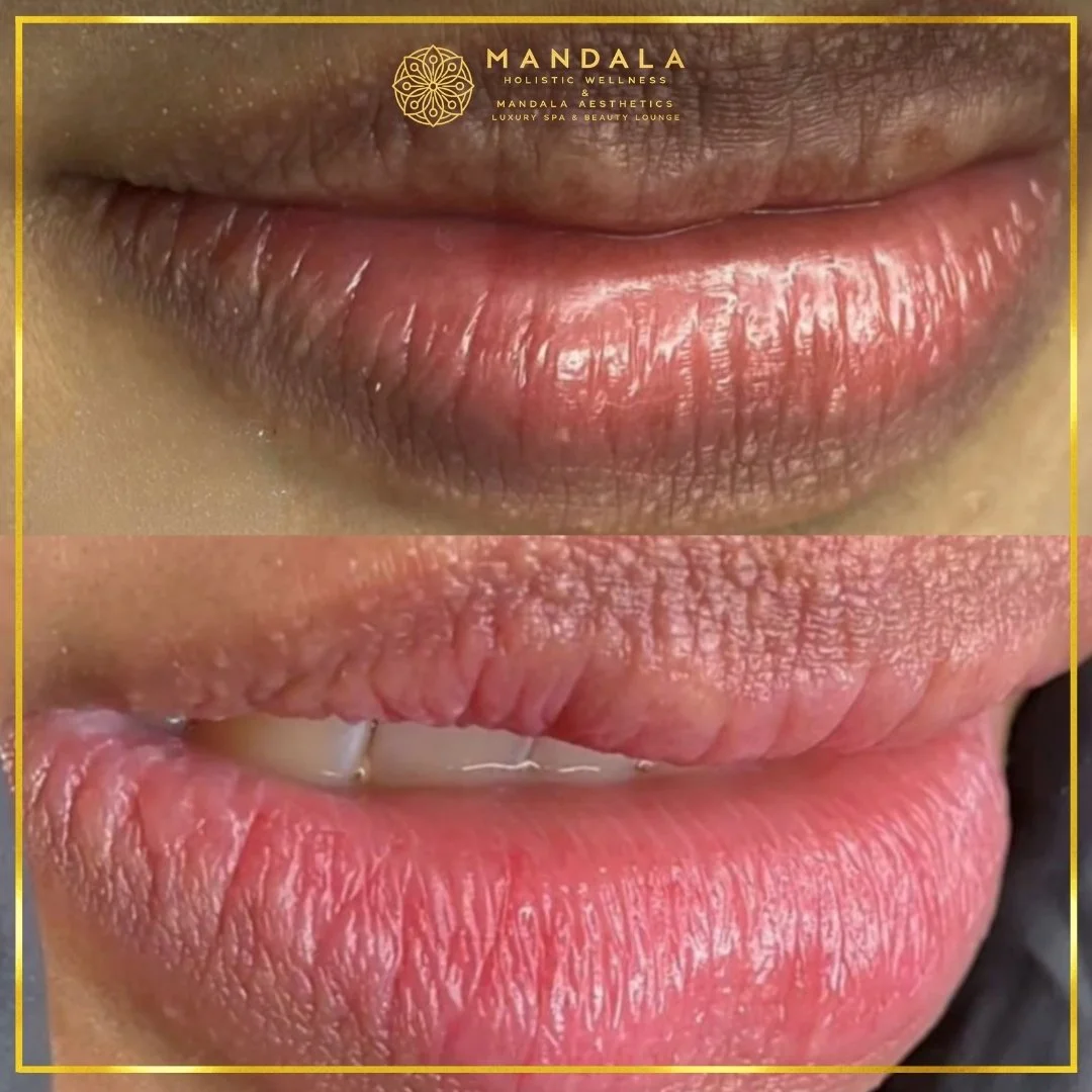 RomaPink Lip Treatment before and after results showing a more even, hydrated lips and naturally pink-looking lip tone at Mandala Aesthetics in Preston, Melbourne.