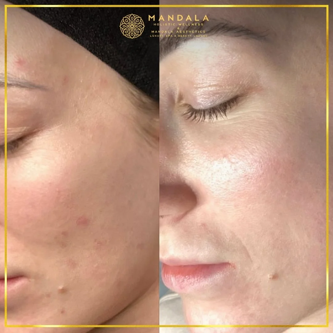 Facial treatment before and after results showing refreshed, hydrated and glowing-looking skin at Mandala Aesthetics in Preston, Melbourne.