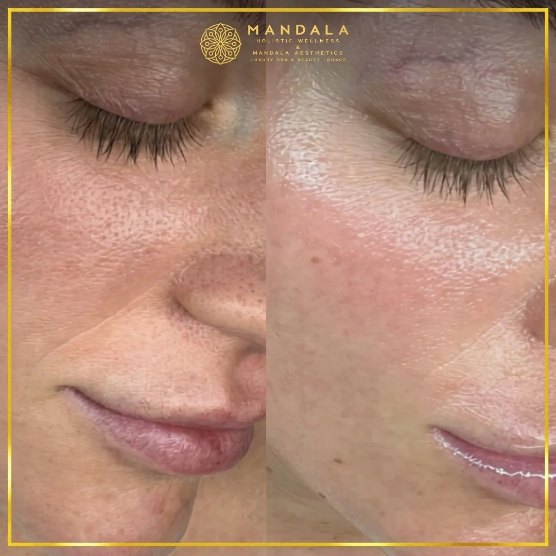 Facial treatment before and after results showing refreshed, hydrated and glowing-looking skin at Mandala Aesthetics in Preston, Melbourne.