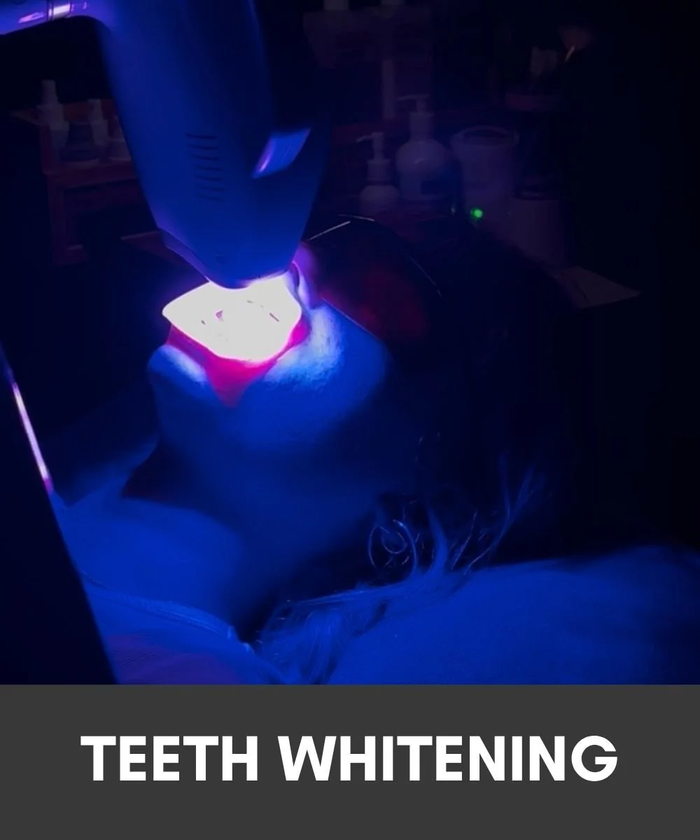 Teeth Whitening Before And After