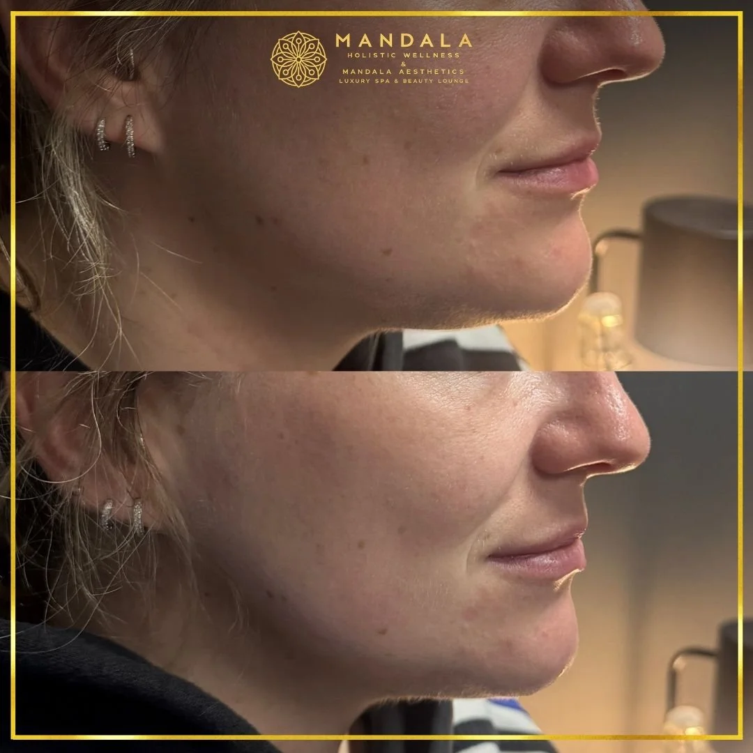 HIFU before and after results showing the lower face, chin and jawline at Mandala Aesthetics in Preston, Melbourne.