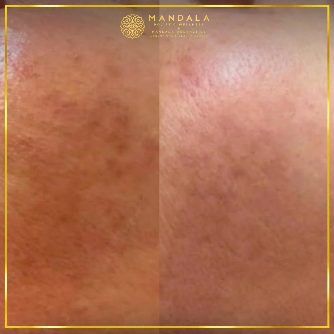 WhiteLab Spot Melanin Removal before and after results showing the appearance of age spots, sun spots , freckles, melasma, pigmentation at Mandala Aesthetics in Preston, Melbourne.