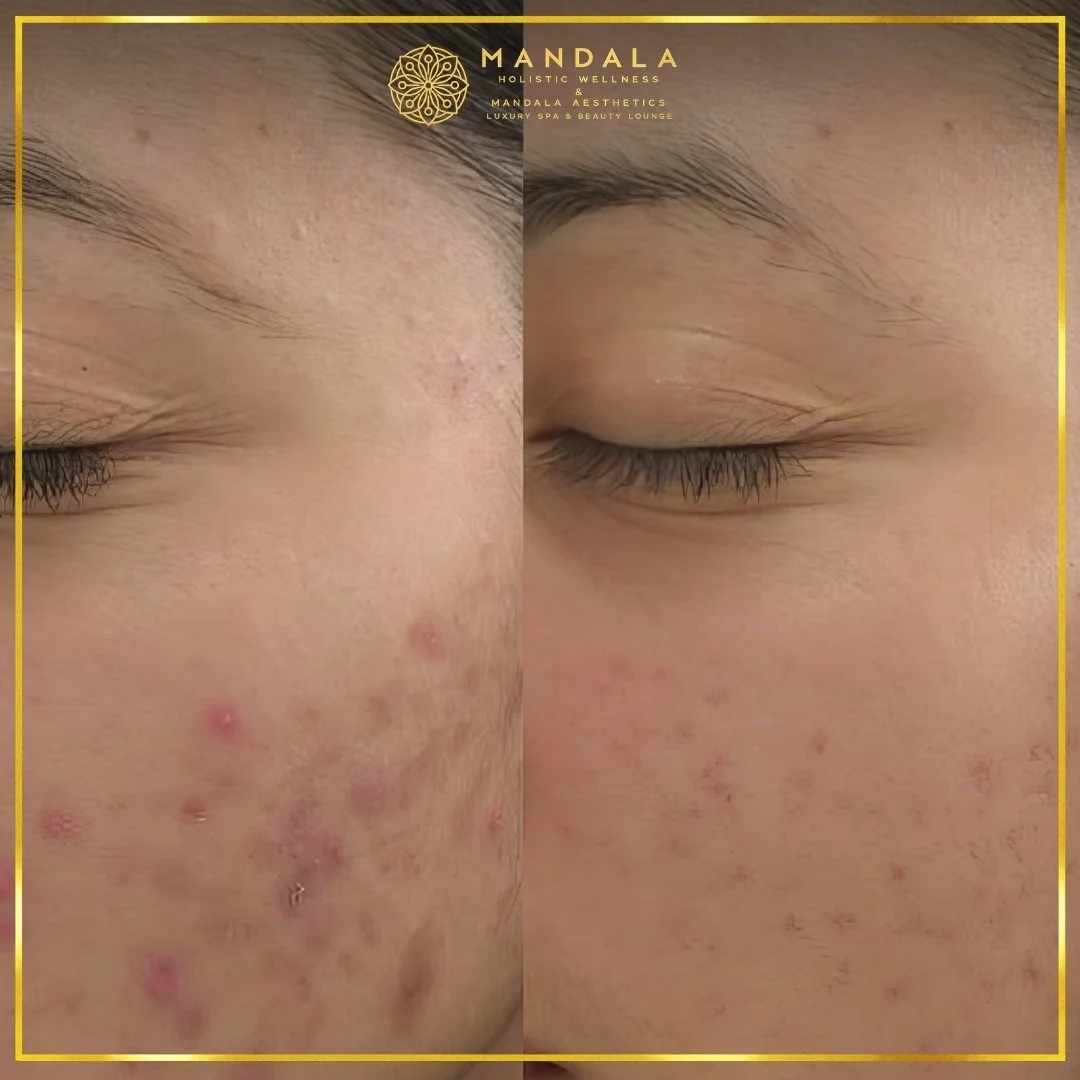 Facial treatment before and after results showing refreshed, hydrated and glowing-looking skin at Mandala Aesthetics in Preston, Melbourne.