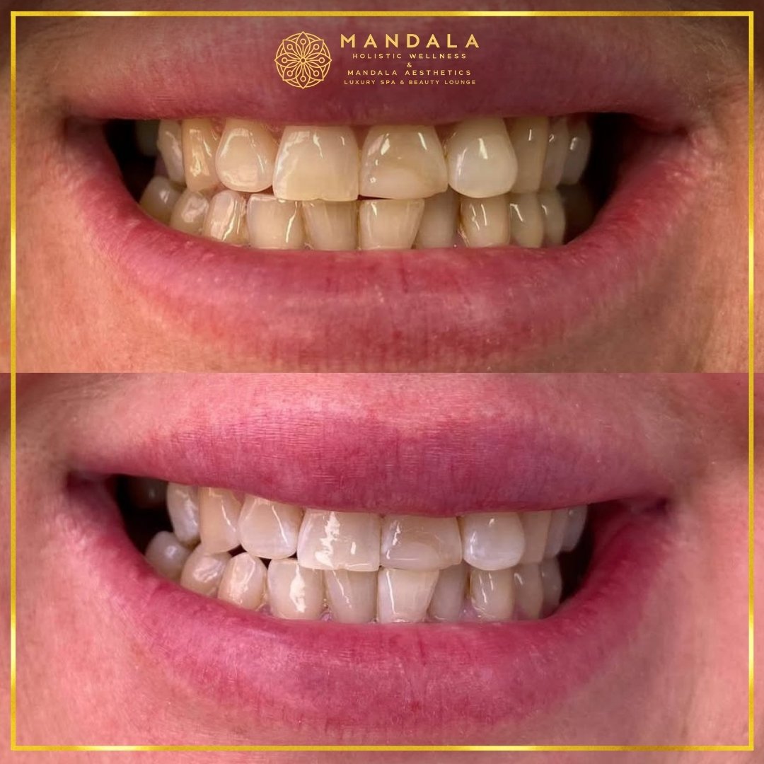 Teeth whitening before and after results showing a visibly white teeth,  brighter-looking smile at Mandala Aesthetics in Preston, Melbourne.