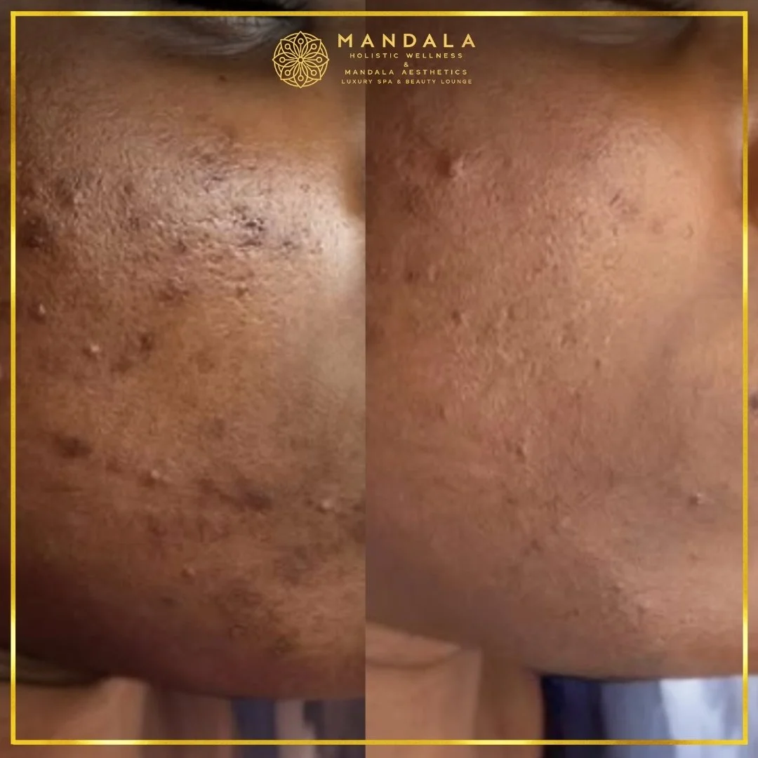 Facial treatment before and after results showing refreshed, hydrated and glowing-looking skin at Mandala Aesthetics in Preston, Melbourne.