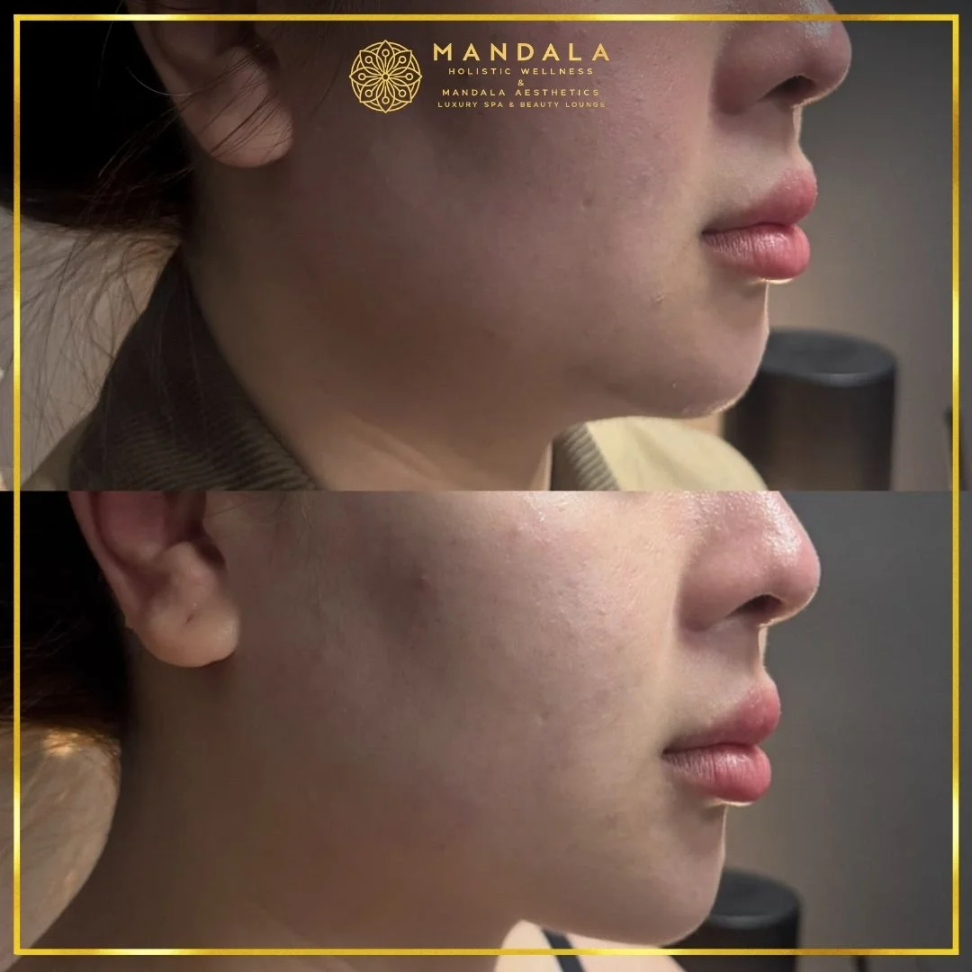HIFU before and after results showing the lower face, chin and jawline at Mandala Aesthetics in Preston, Melbourne.