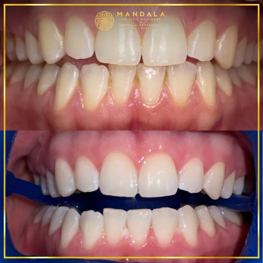 Teeth whitening before and after results showing a visibly white teeth,  brighter-looking smile at Mandala Aesthetics in Preston, Melbourne.