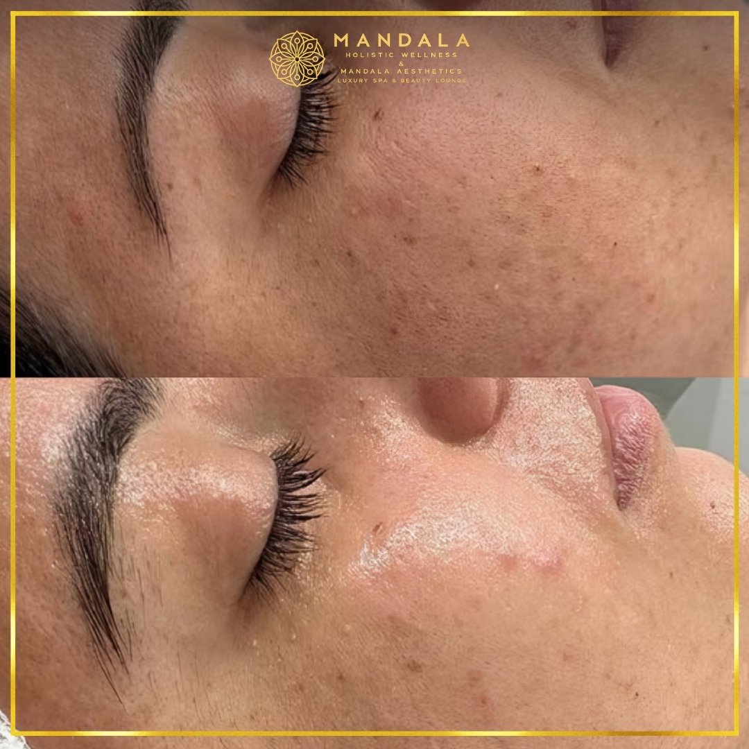Facial treatment before and after results showing refreshed, hydrated and glowing-looking skin at Mandala Aesthetics in Preston, Melbourne.