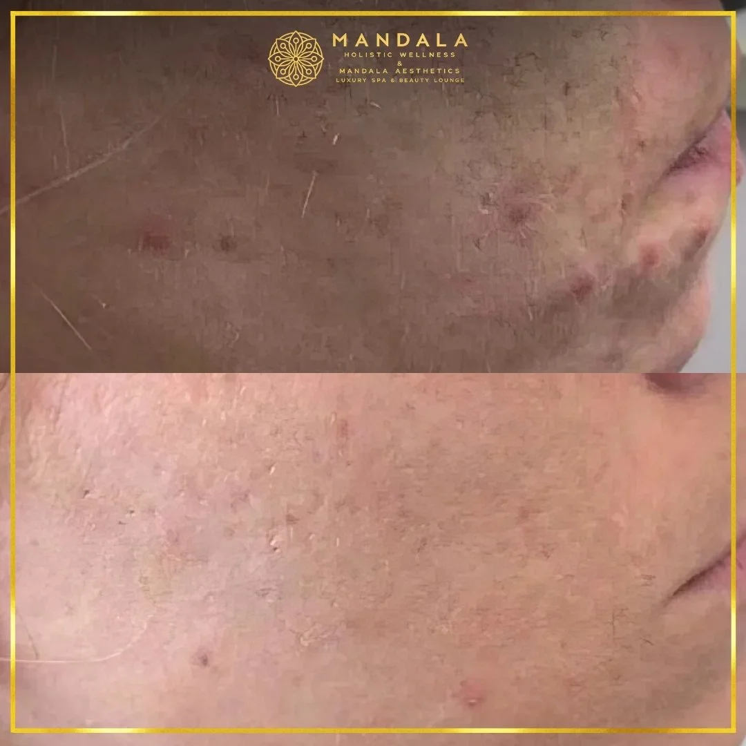 RF Microneedling before and after results showing improved-looking skin texture  and acne scars at Mandala Aesthetics in Preston, Melbourne.