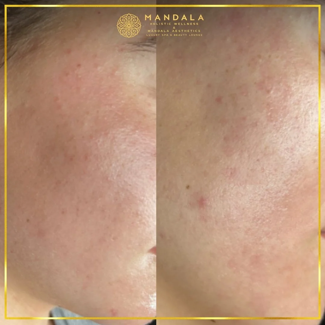 Facial treatment before and after results showing refreshed, hydrated and glowing-looking skin at Mandala Aesthetics in Preston, Melbourne.