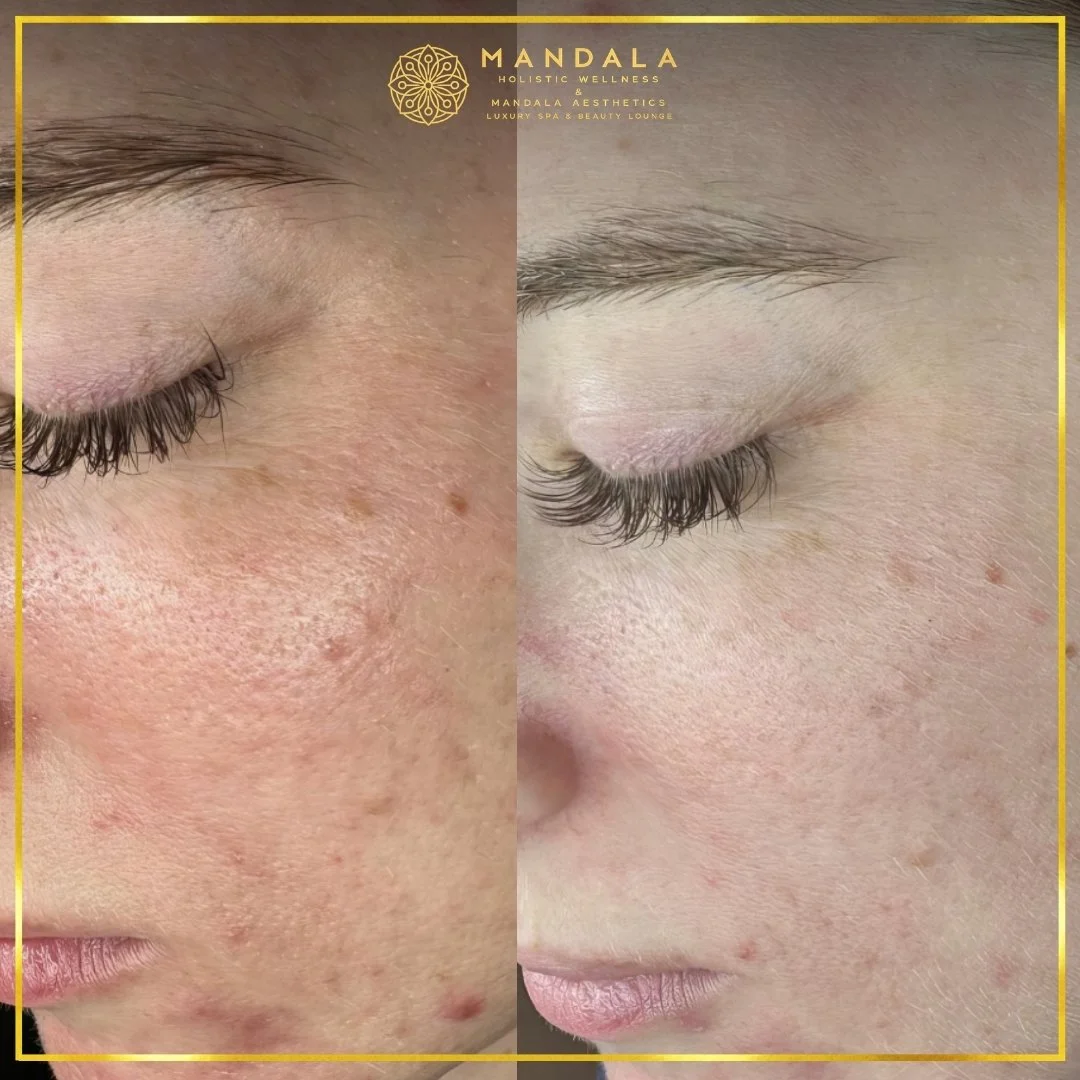 Facial treatment before and after results showing refreshed, hydrated and glowing-looking skin at Mandala Aesthetics in Preston, Melbourne.