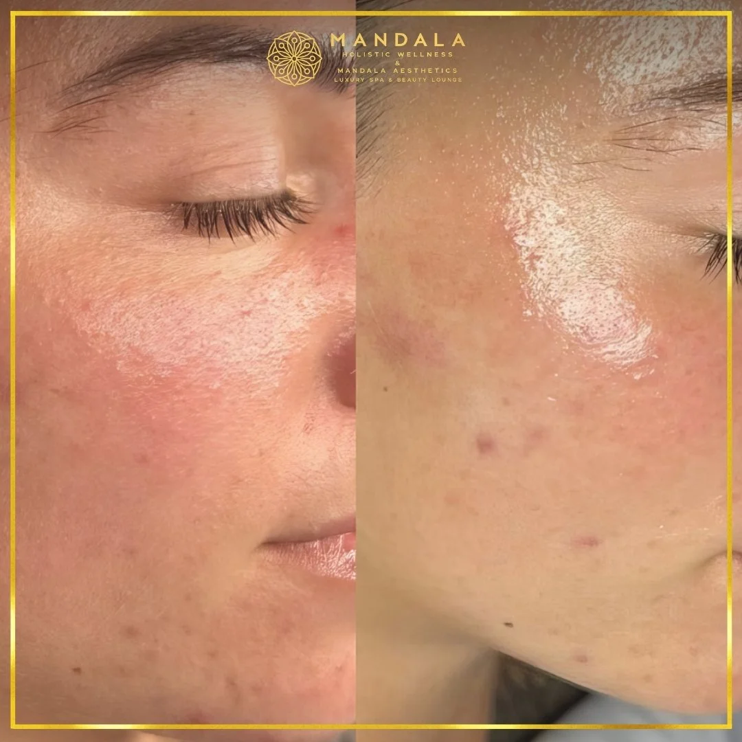 Facial treatment before and after results showing refreshed, hydrated and glowing-looking skin at Mandala Aesthetics in Preston, Melbourne.