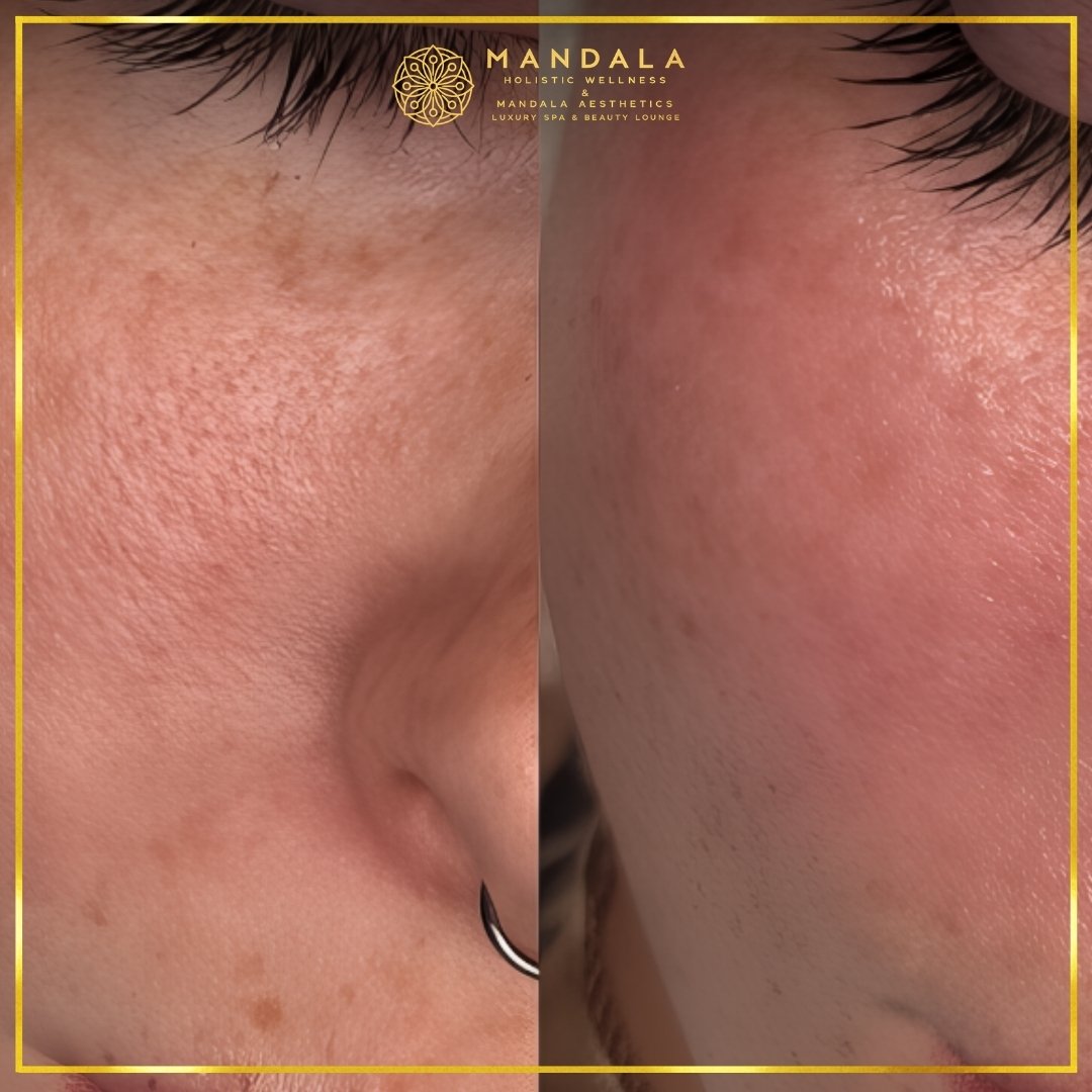 RF Microneedling before and after results showing improved-looking skin texture  and acne scars at Mandala Aesthetics in Preston, Melbourne.