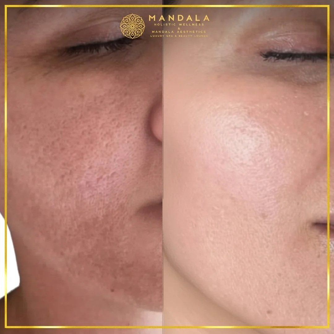 RF Microneedling before and after results showing improved-looking skin texture  and acne scars at Mandala Aesthetics in Preston, Melbourne.