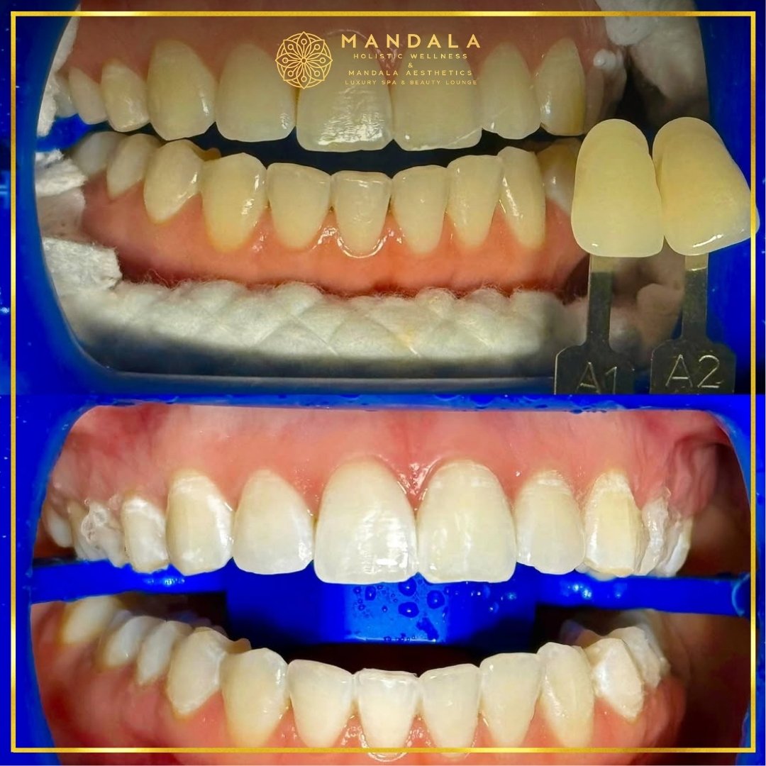 Teeth whitening before and after results showing a visibly white teeth,  brighter-looking smile at Mandala Aesthetics in Preston, Melbourne.