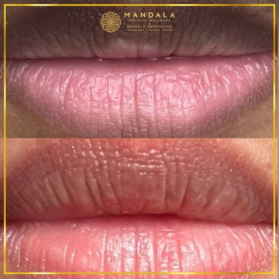 RomaPink Lip Treatment before and after results showing a more even, hydrated lips and naturally pink-looking lip tone at Mandala Aesthetics in Preston, Melbourne.