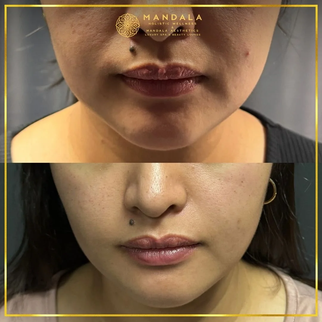 HIFU before and after results showing the lower face, chin and jawline at Mandala Aesthetics in Preston, Melbourne.