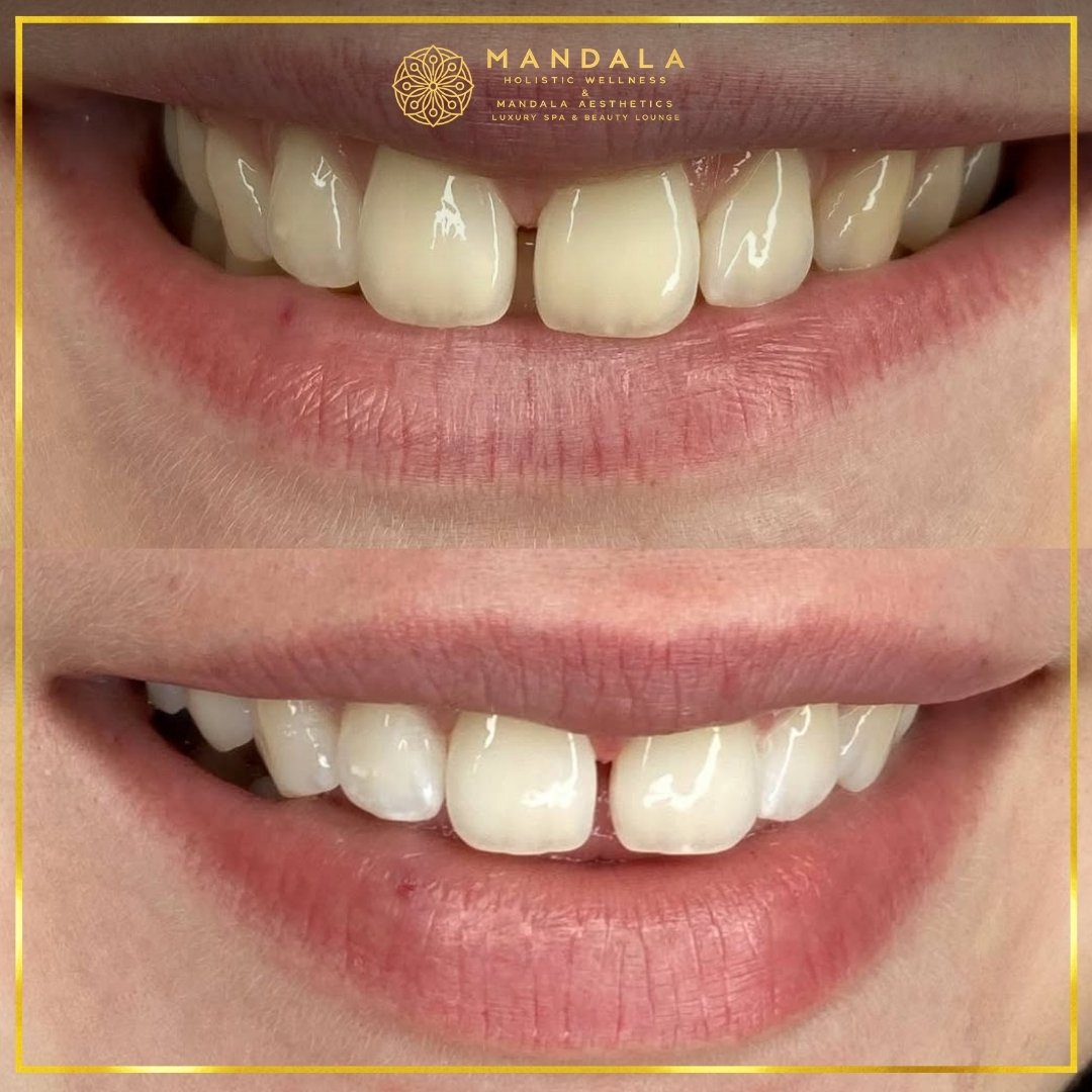 Teeth whitening before and after results showing a visibly white teeth,  brighter-looking smile at Mandala Aesthetics in Preston, Melbourne.