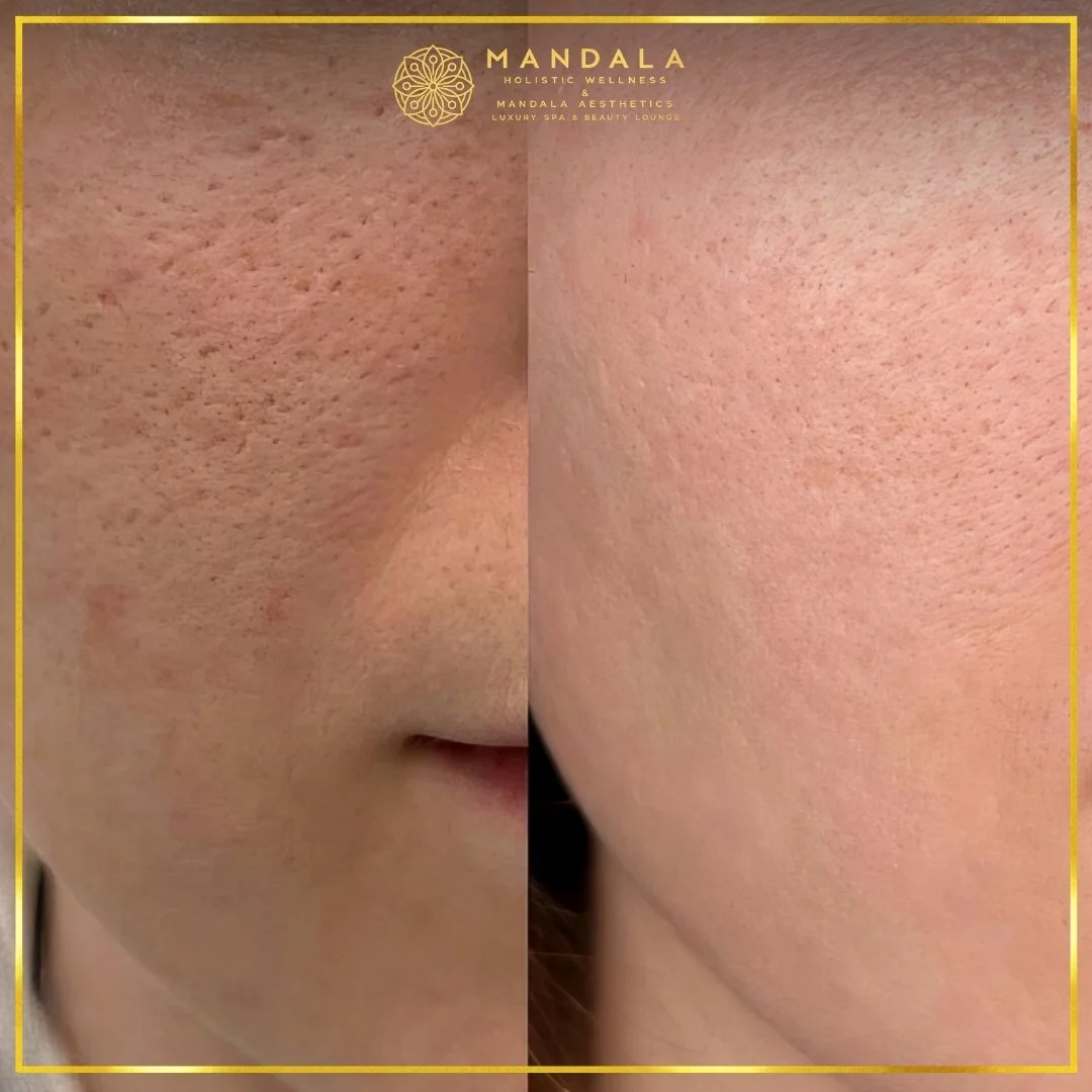 RF Microneedling before and after results showing improved-looking skin texture  and acne scars at Mandala Aesthetics in Preston, Melbourne.