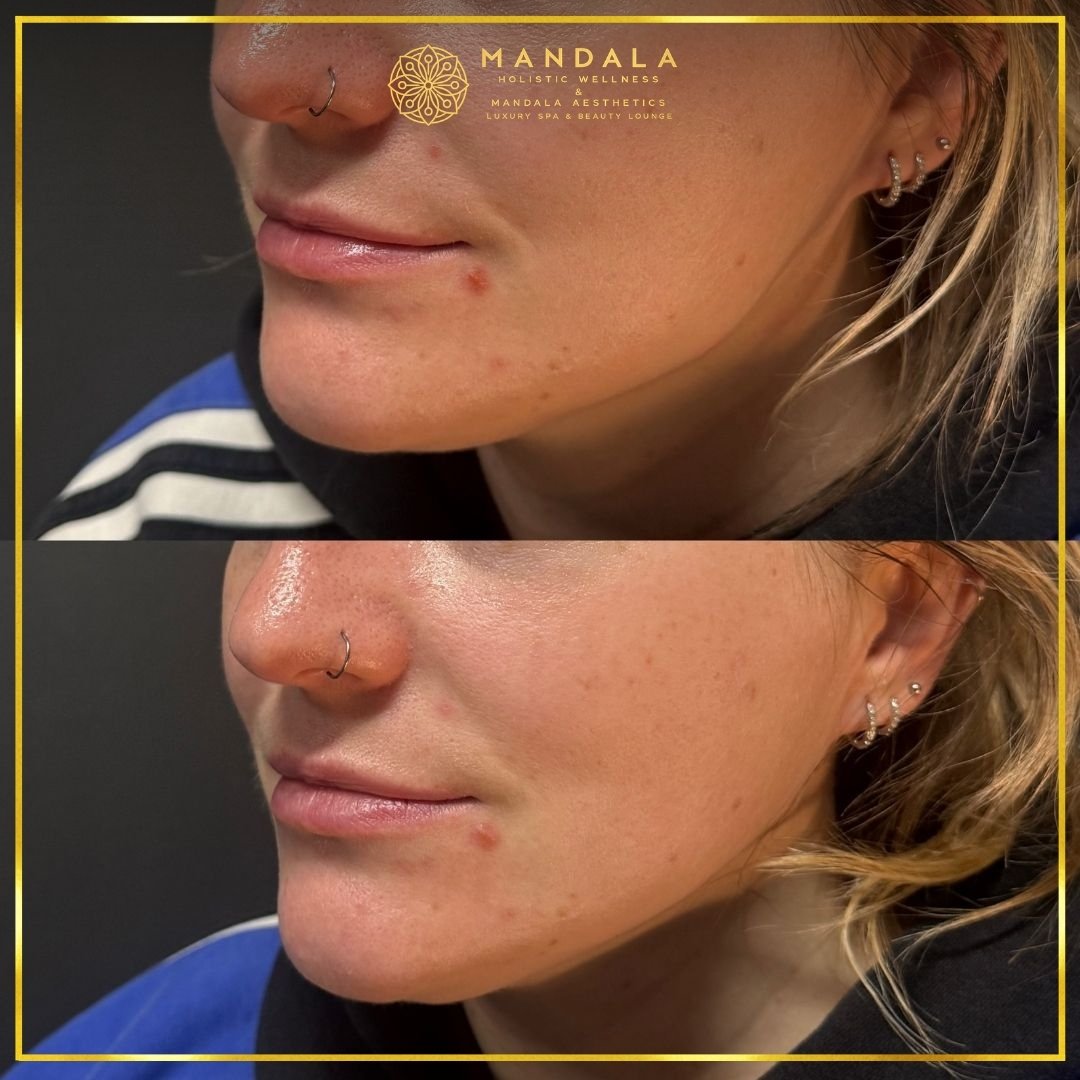 HIFU before and after results showing the lower face, chin and jawline at Mandala Aesthetics in Preston, Melbourne.