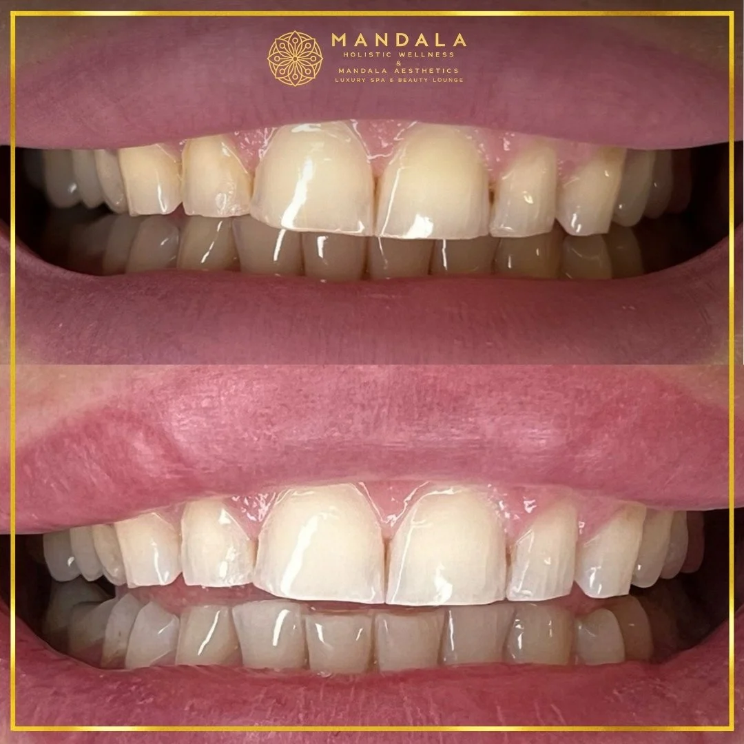 Teeth whitening before and after results showing a visibly white teeth,  brighter-looking smile at Mandala Aesthetics in Preston, Melbourne.