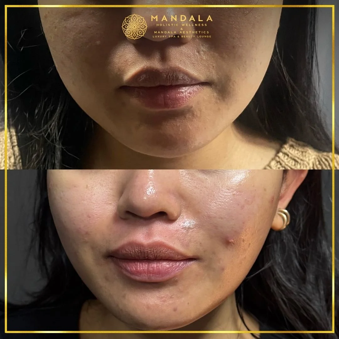 HIFU before and after results showing the lower face, chin and jawline at Mandala Aesthetics in Preston, Melbourne.