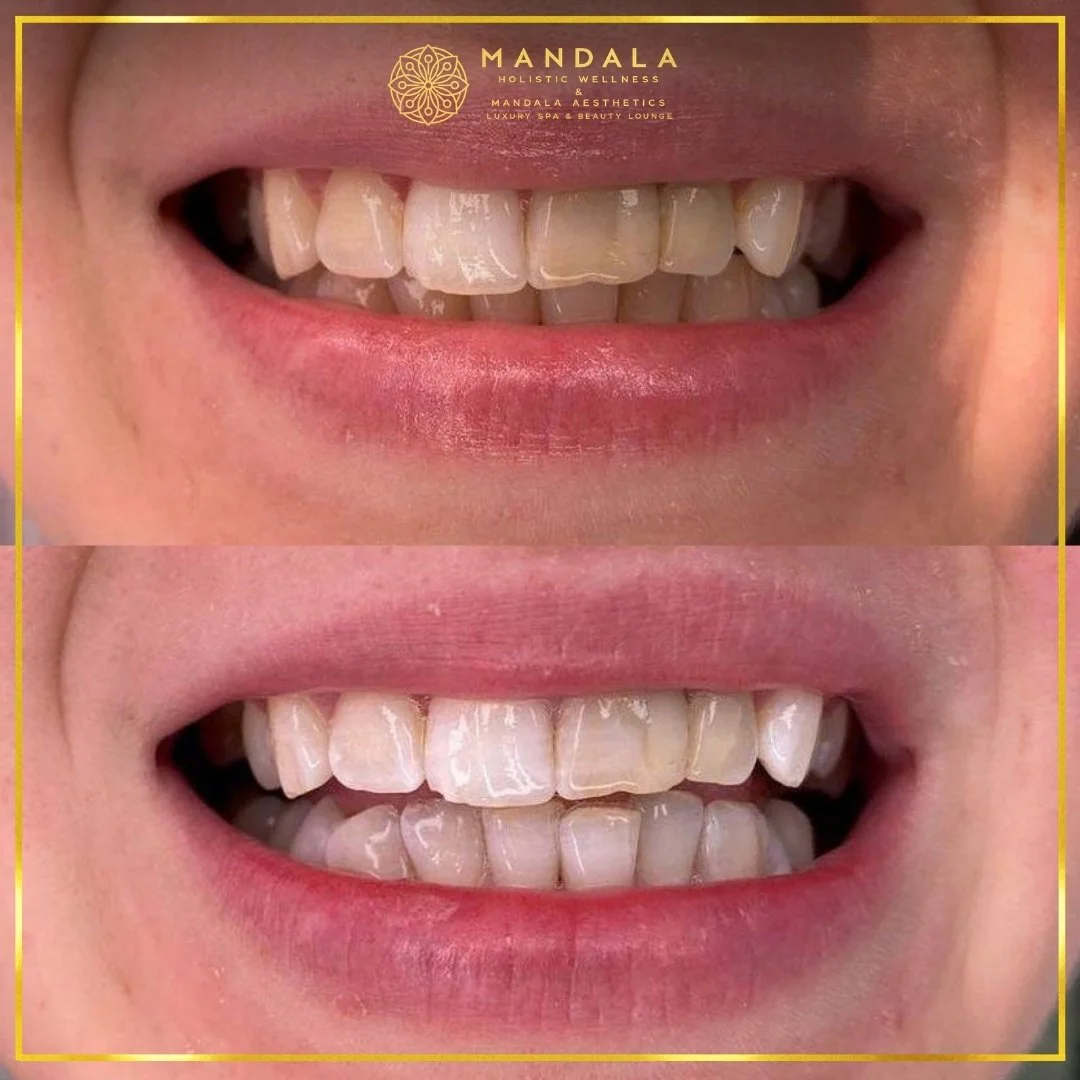 Teeth whitening before and after results showing a visibly white teeth,  brighter-looking smile at Mandala Aesthetics in Preston, Melbourne.