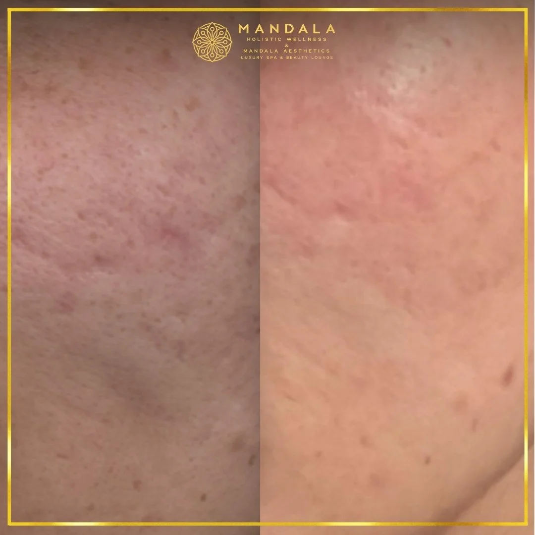RF Microneedling before and after results showing improved-looking skin texture  and acne scars at Mandala Aesthetics in Preston, Melbourne.