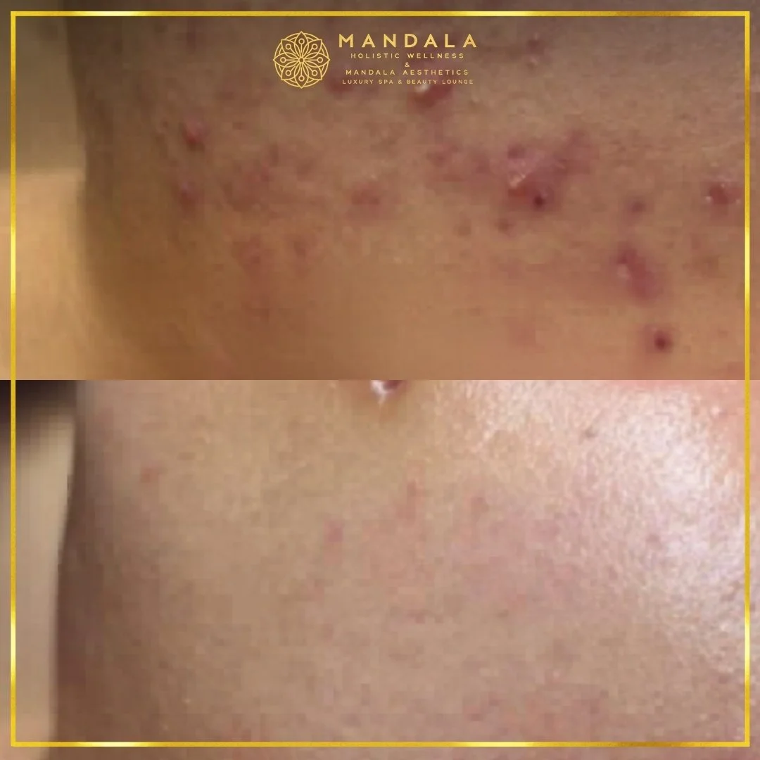 Facial treatment before and after results showing refreshed, hydrated and glowing-looking skin at Mandala Aesthetics in Preston, Melbourne.
