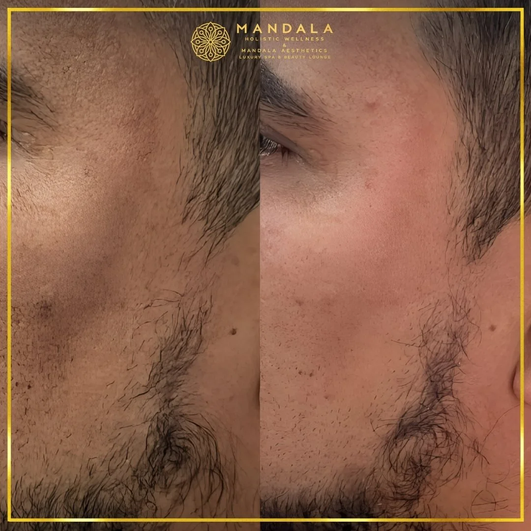 WhiteLab Spot Melanin Removal before and after results showing the appearance of age spots, sun spots , freckles, melasma, pigmentation at Mandala Aesthetics in Preston, Melbourne.