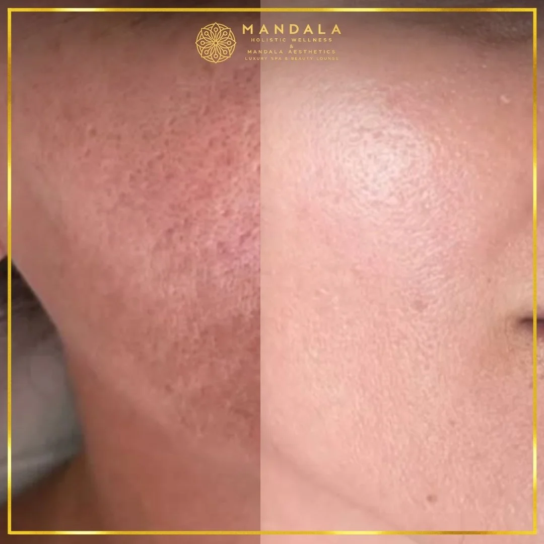 RF Microneedling before and after results showing improved-looking skin texture  and acne scars at Mandala Aesthetics in Preston, Melbourne.