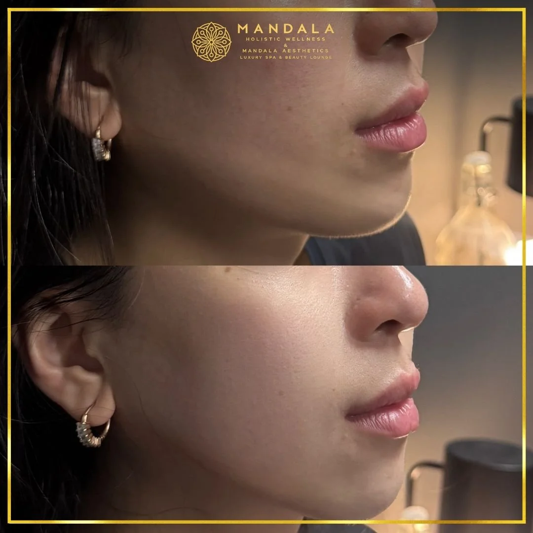 HIFU before and after results showing the lower face, chin and jawline at Mandala Aesthetics in Preston, Melbourne.