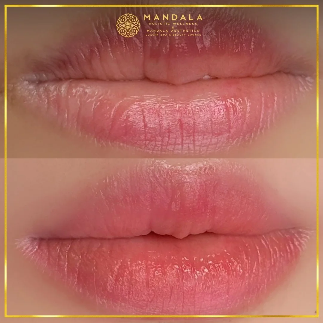 RomaPink Lip Treatment before and after results showing a more even, hydrated lips and naturally pink-looking lip tone at Mandala Aesthetics in Preston, Melbourne.