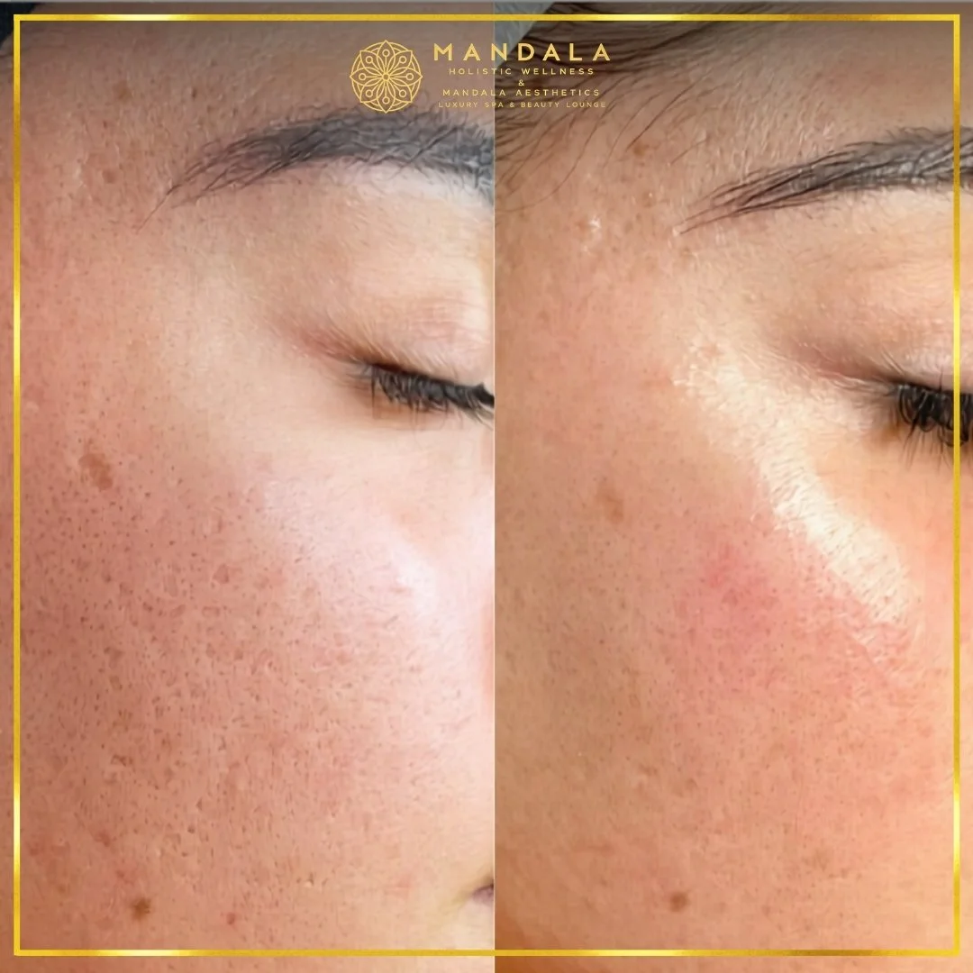 RF Microneedling before and after results showing improved-looking skin texture  and acne scars at Mandala Aesthetics in Preston, Melbourne.