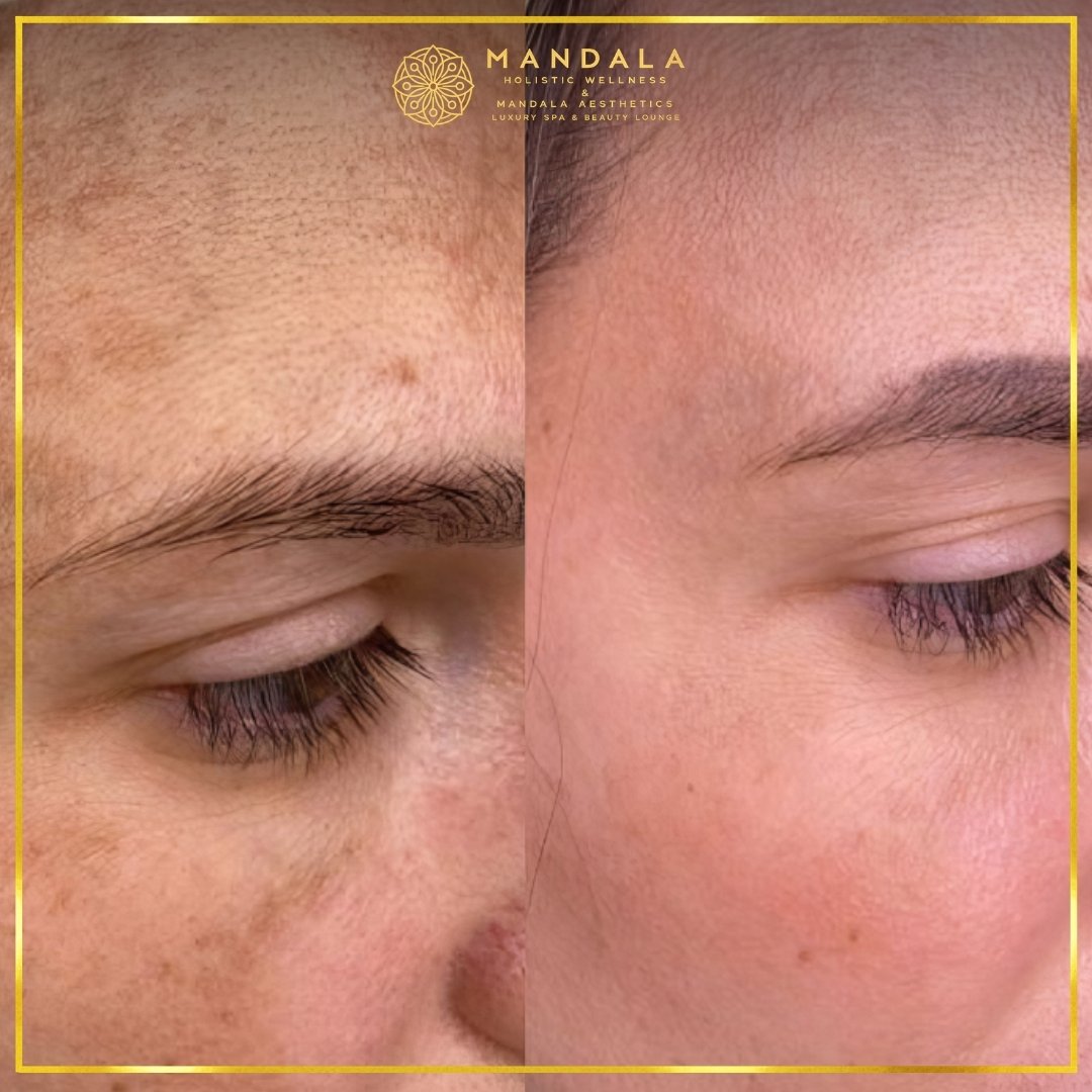 WhiteLab Spot Melanin Removal before and after results showing the appearance of age spots, sun spots , freckles, melasma, pigmentation at Mandala Aesthetics in Preston, Melbourne.