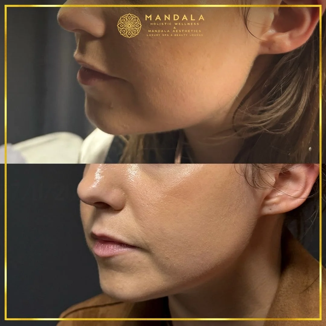 HIFU before and after results showing the lower face, chin and jawline at Mandala Aesthetics in Preston, Melbourne.
