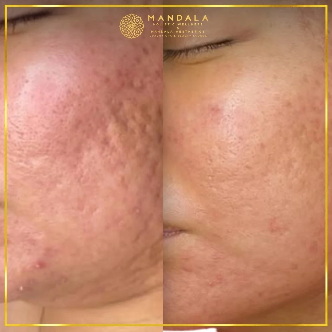 RF Microneedling before and after results showing improved-looking skin texture  and acne scars at Mandala Aesthetics in Preston, Melbourne.