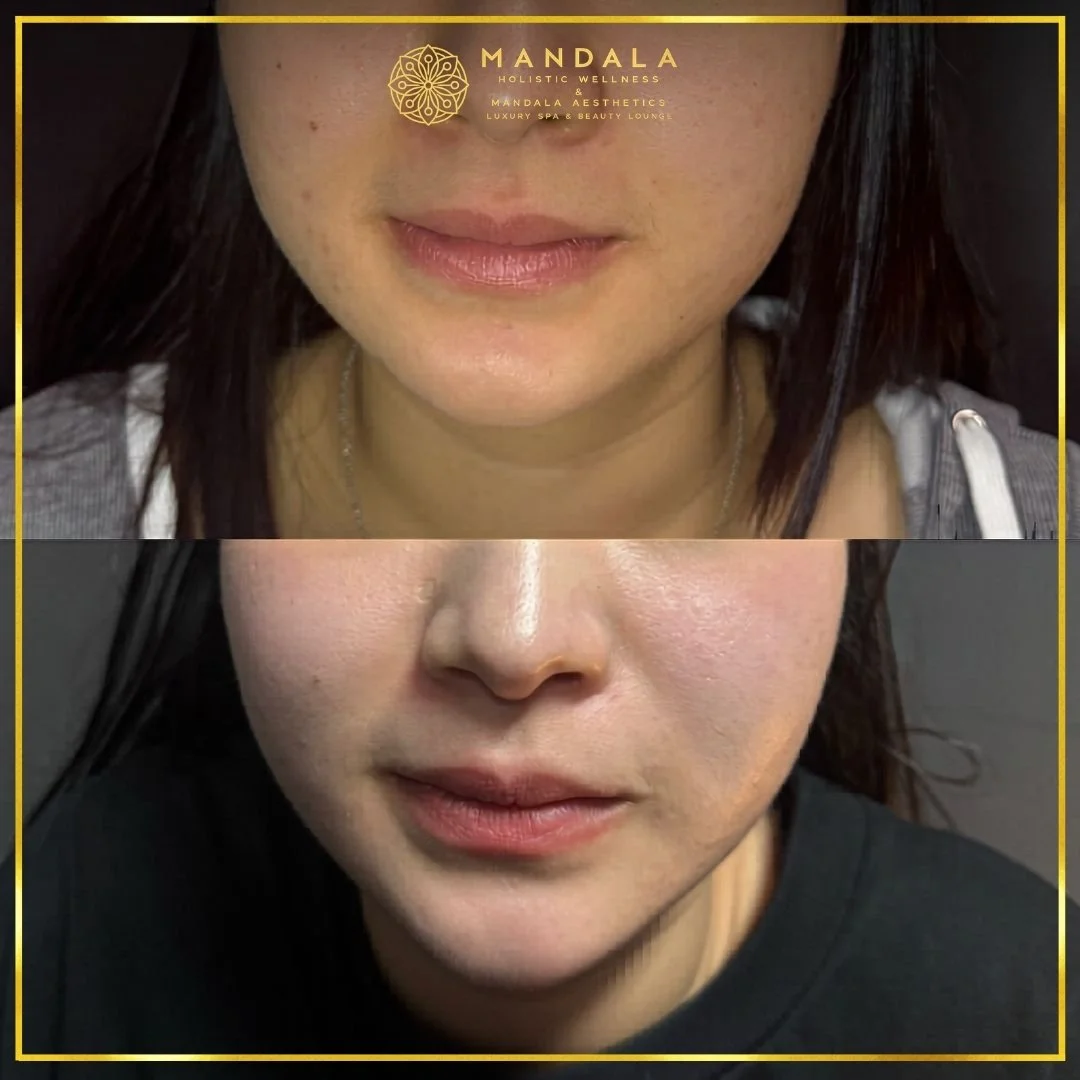 HIFU before and after results showing the lower face, chin and jawline at Mandala Aesthetics in Preston, Melbourne.