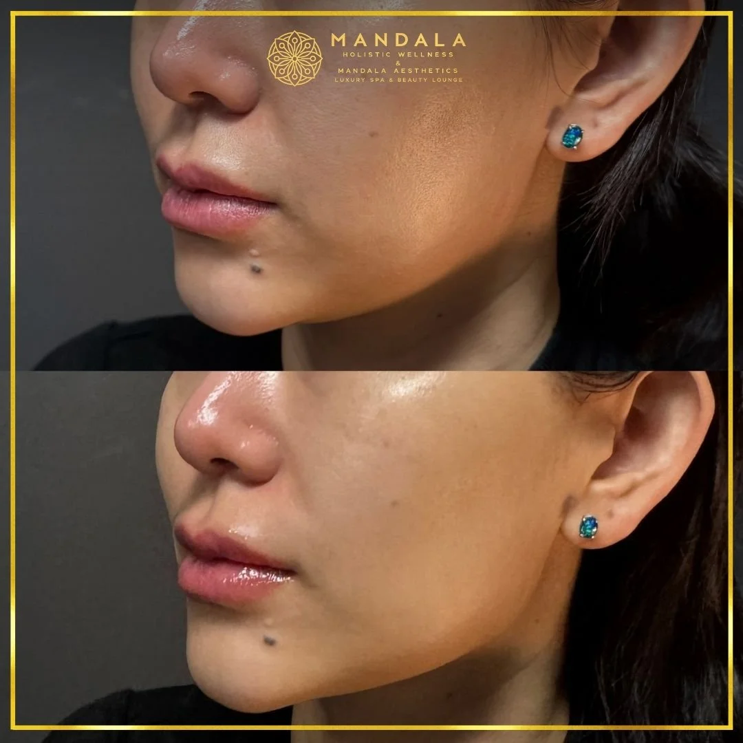 HIFU before and after results showing the lower face, chin and jawline at Mandala Aesthetics in Preston, Melbourne.