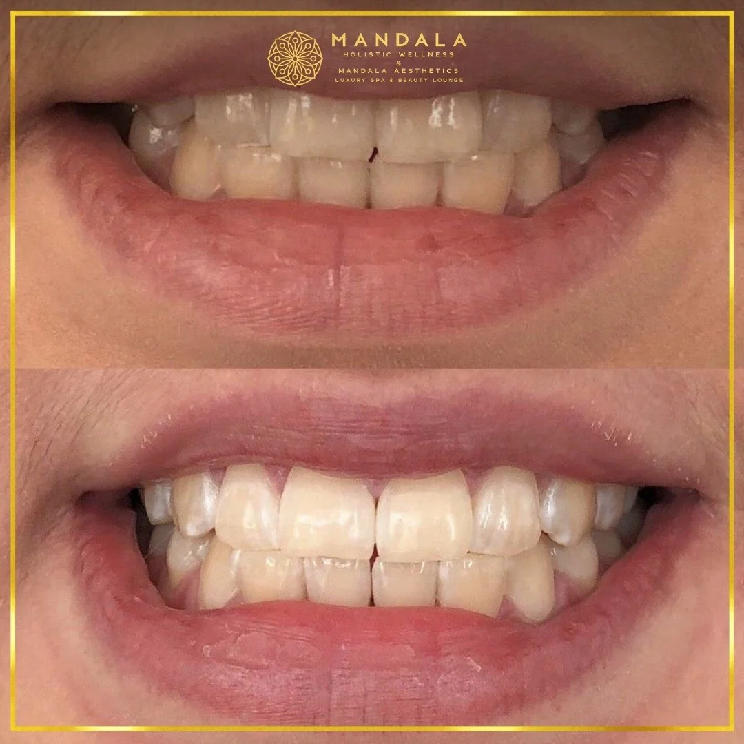 Teeth whitening before and after results showing a visibly white teeth,  brighter-looking smile at Mandala Aesthetics in Preston, Melbourne.