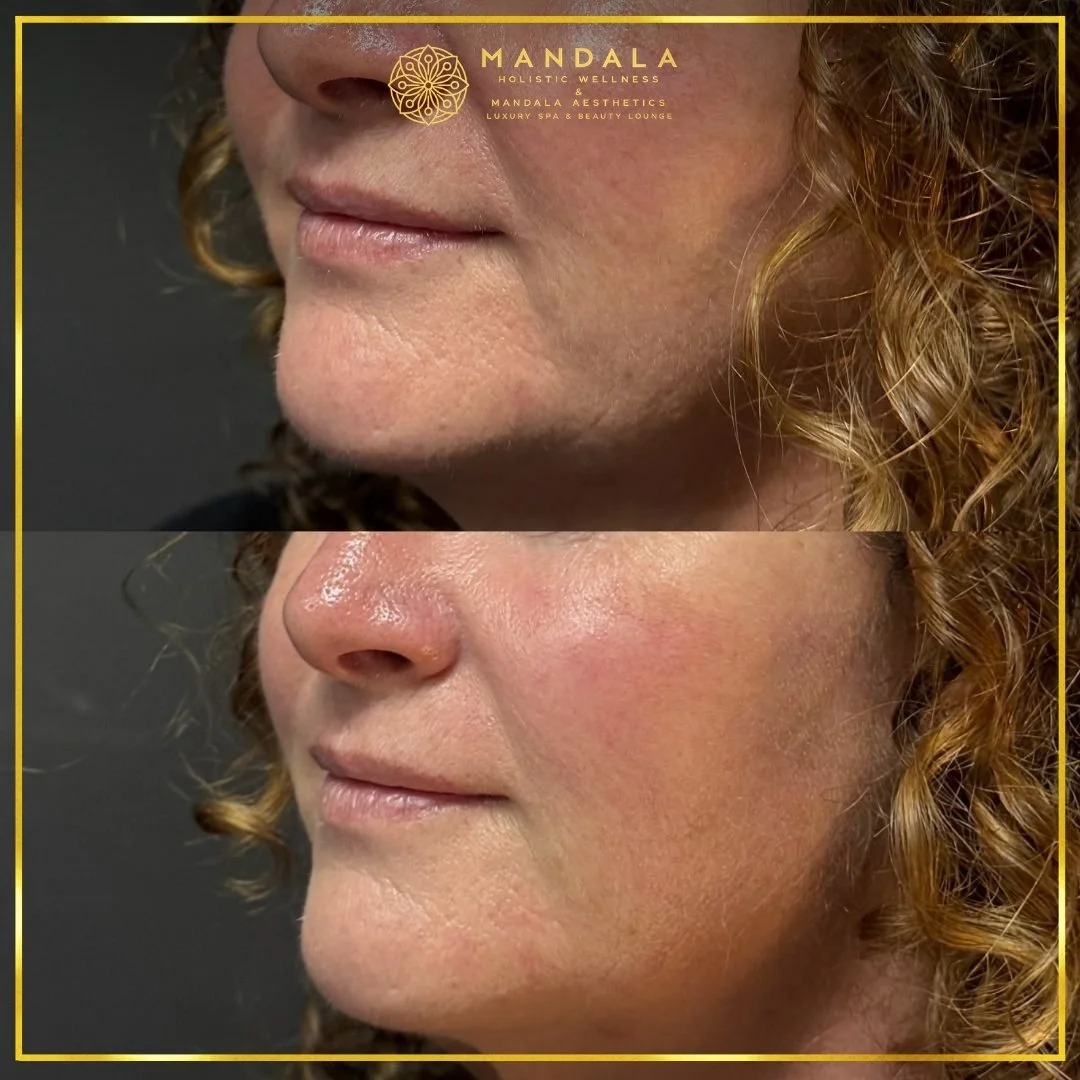 HIFU before and after results showing the lower face, chin and jawline at Mandala Aesthetics in Preston, Melbourne.