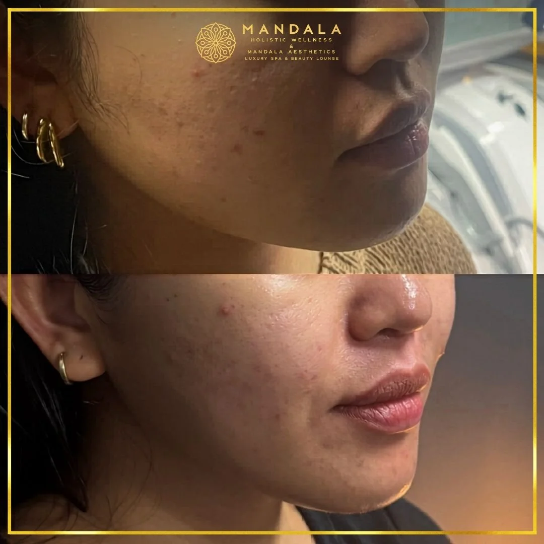 HIFU before and after results showing the lower face, chin and jawline at Mandala Aesthetics in Preston, Melbourne.