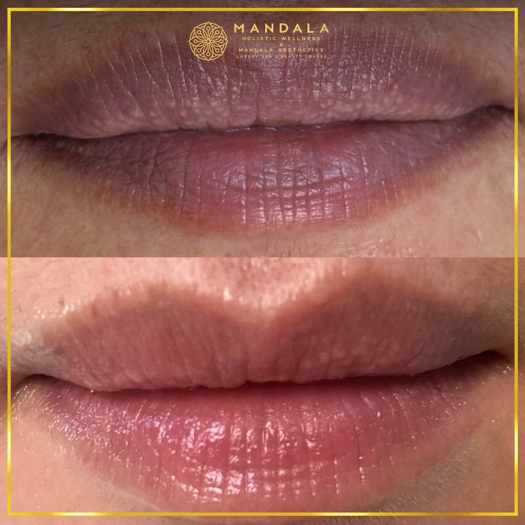 RomaPink Lip Treatment before and after results showing a more even, hydrated lips and naturally pink-looking lip tone at Mandala Aesthetics in Preston, Melbourne.