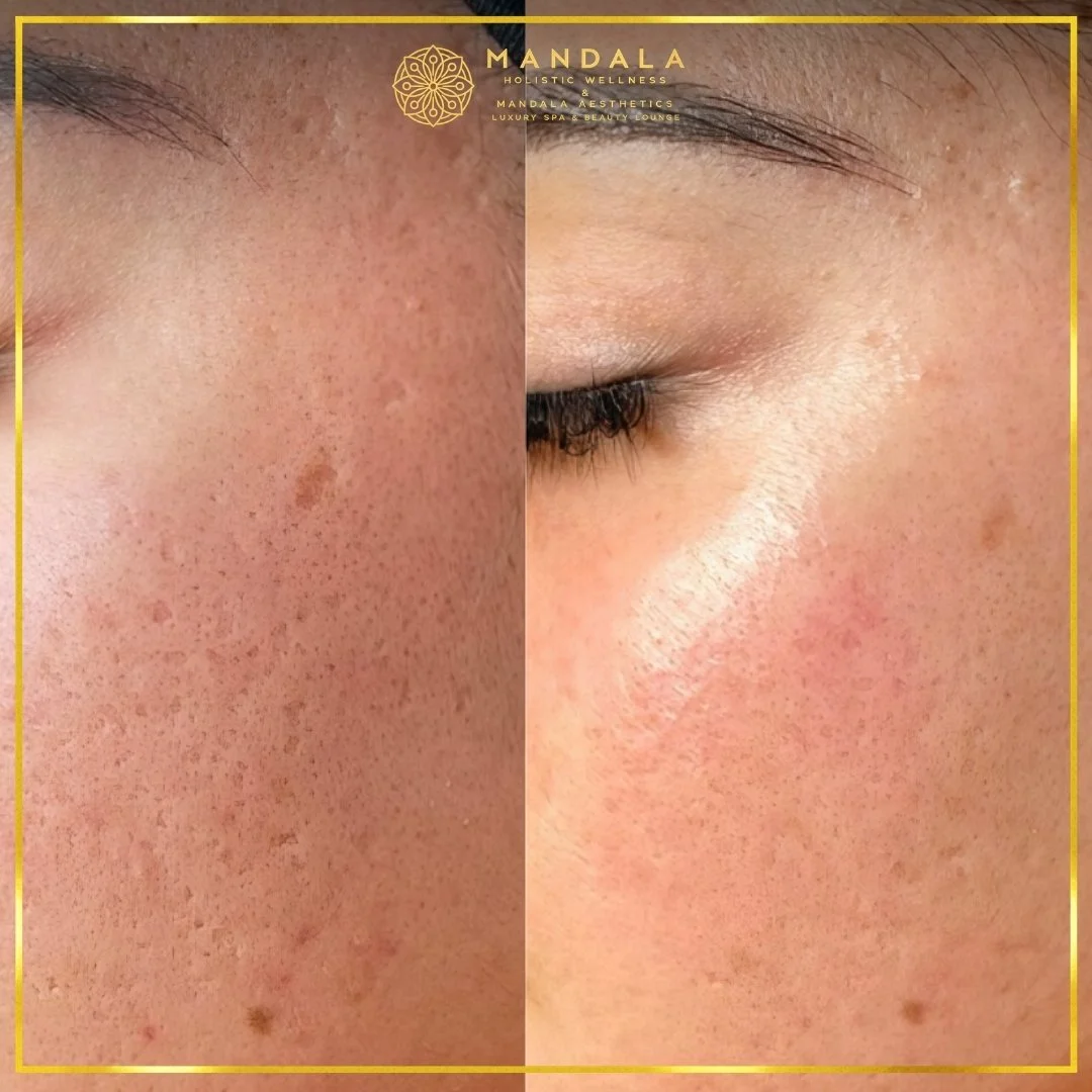 RF Microneedling before and after results showing improved-looking skin texture  and acne scars at Mandala Aesthetics in Preston, Melbourne.