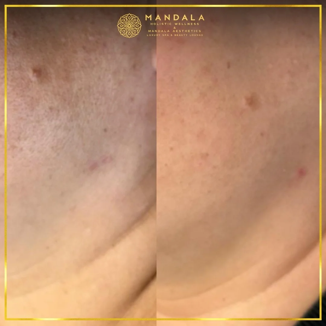 Facial treatment before and after results showing refreshed, hydrated and glowing-looking skin at Mandala Aesthetics in Preston, Melbourne.