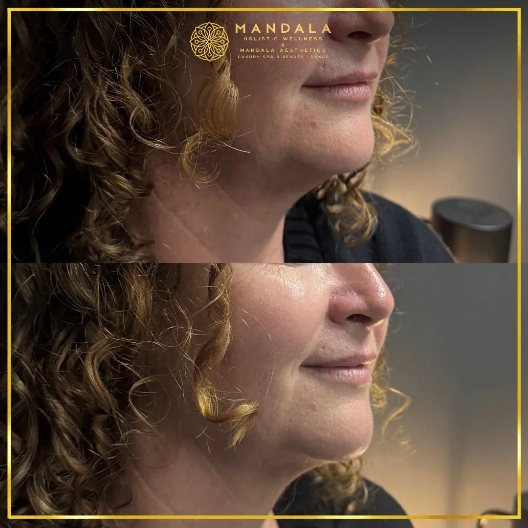 HIFU before and after results showing the lower face, chin and jawline at Mandala Aesthetics in Preston, Melbourne.