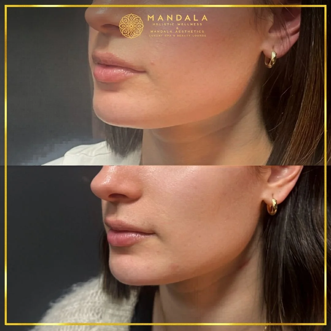 HIFU before and after results showing the lower face, chin and jawline at Mandala Aesthetics in Preston, Melbourne.