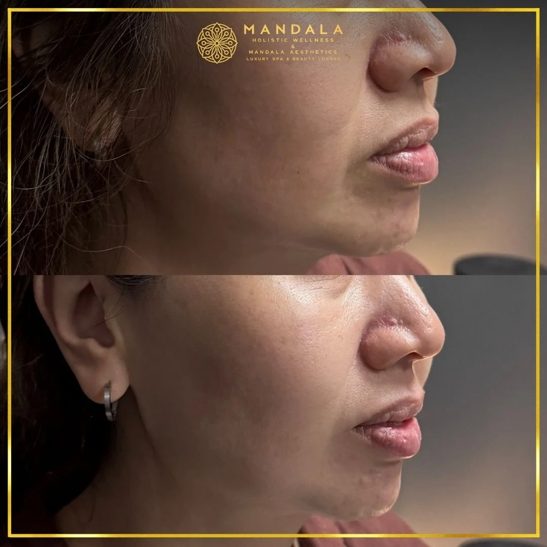 HIFU before and after results showing the lower face, chin and jawline at Mandala Aesthetics in Preston, Melbourne.